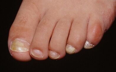 Reasons for the appearance of mushrooms on the thumb of the leg