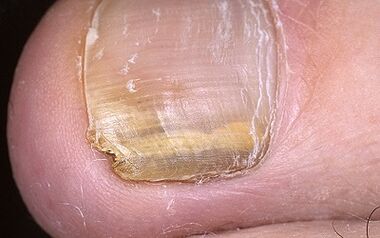 The manifestation of mushrooms on the thumb