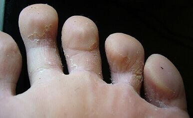 What mushrooms look like on the feet and treatment