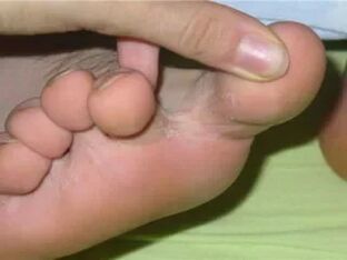Itching toes