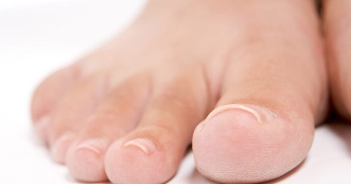 Toenails can be affected by fungal infections