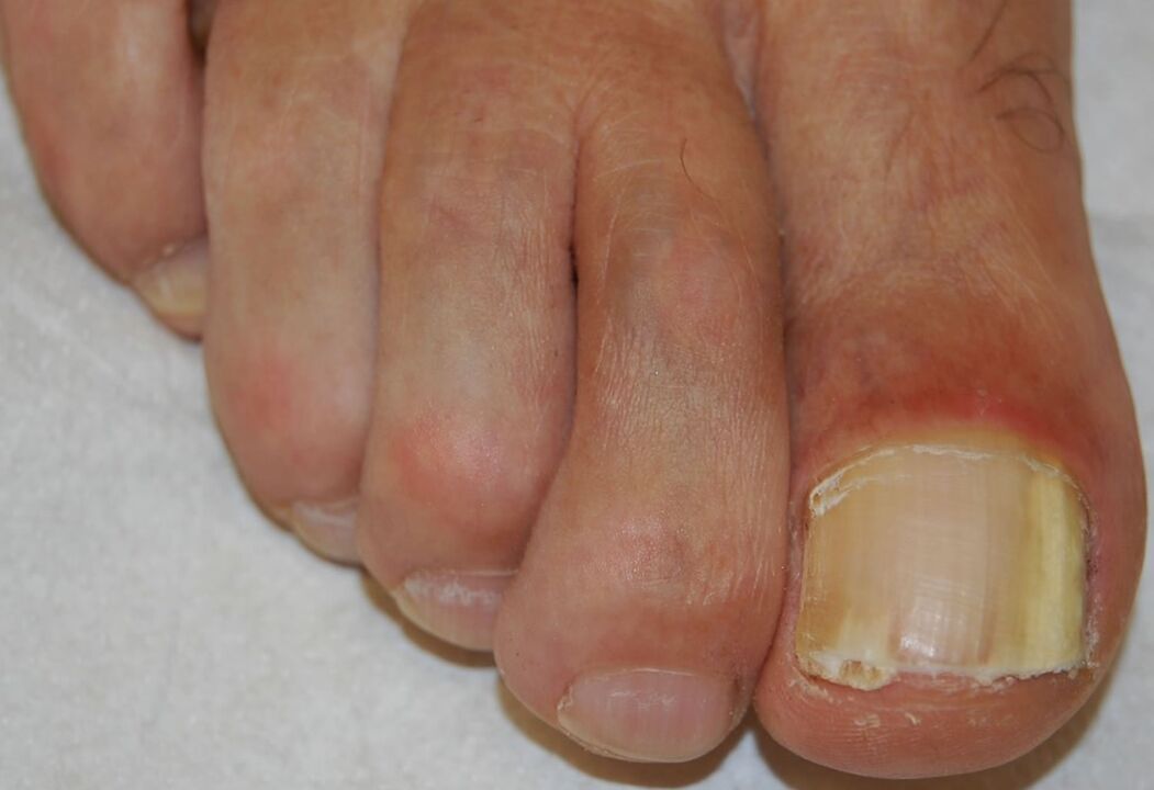 Subungual onychomycosis on the distal foot